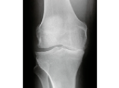 Diagnoza artrozy stawu kolanowego