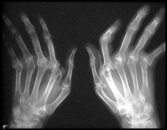 X -Ray Obraz dłoni dotkniętych artrozą