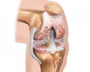 początkowy etap artrozy kolana