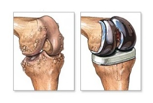 wymiana kolana w przypadku artrozy