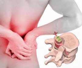 Lumbago na początku choroby osteochondrozy