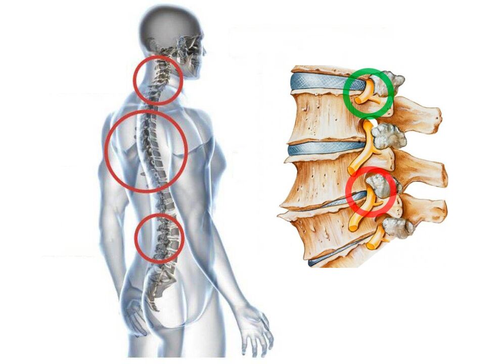 Jak wygląda osteochondroza szyjna kręgów