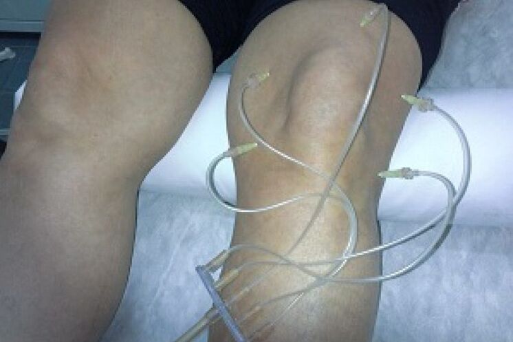 Terapia ozonem