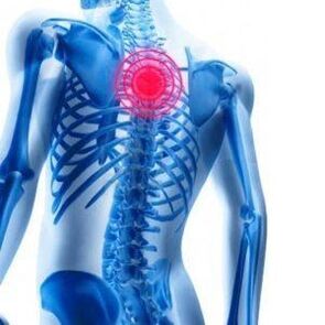 ból pleców w osteochondrozie klatki piersiowej