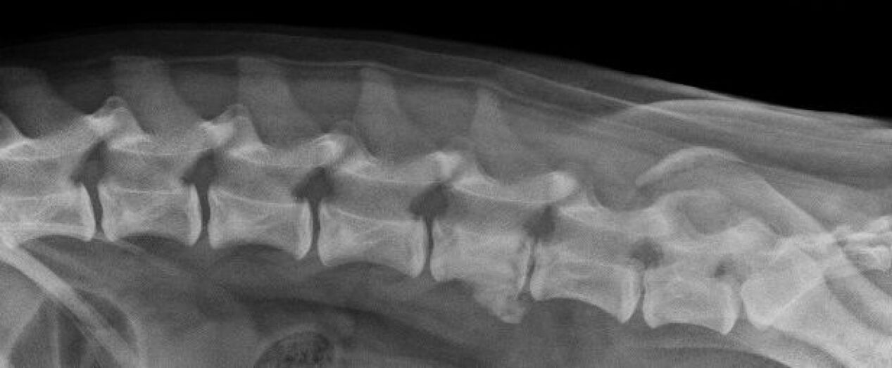 Objawy osteochondrozy kręgosłupa piersiowego na zdjęciu rentgenowskim