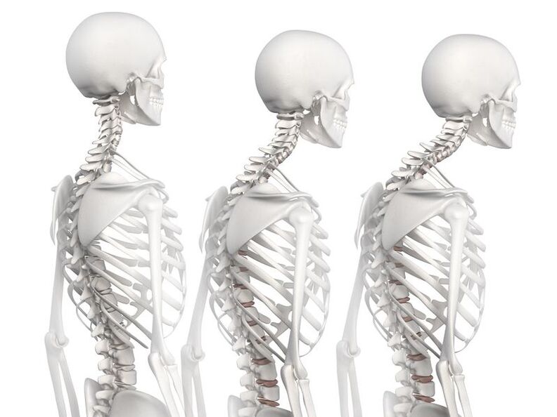 Stopnie rozwoju osteochondrozy klatki piersiowej na przykładzie modelu szkieletowego