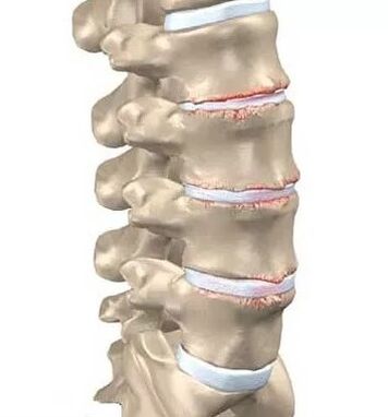 Osteochondroza